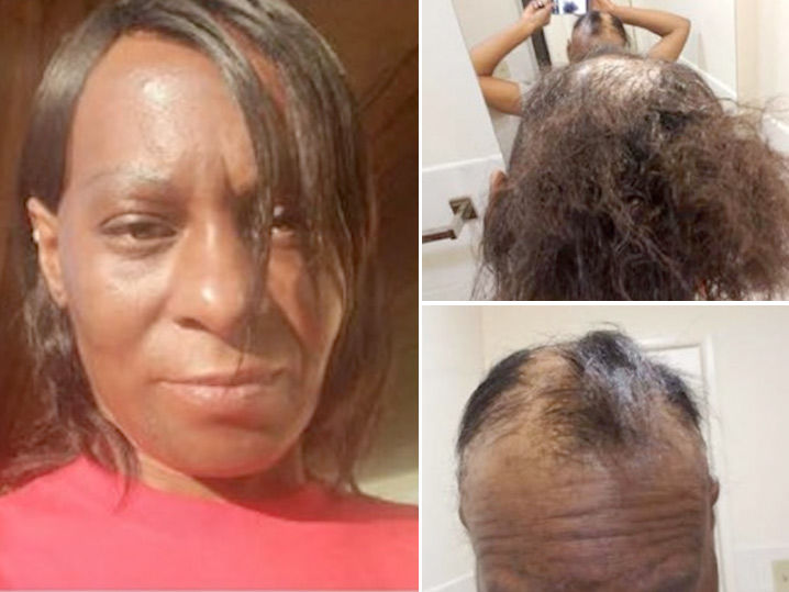 LOréal Sued By Customer Who Claims Product Burned Her Bald LOréal Sued By Customer Who Claims Product Burned Her Bald