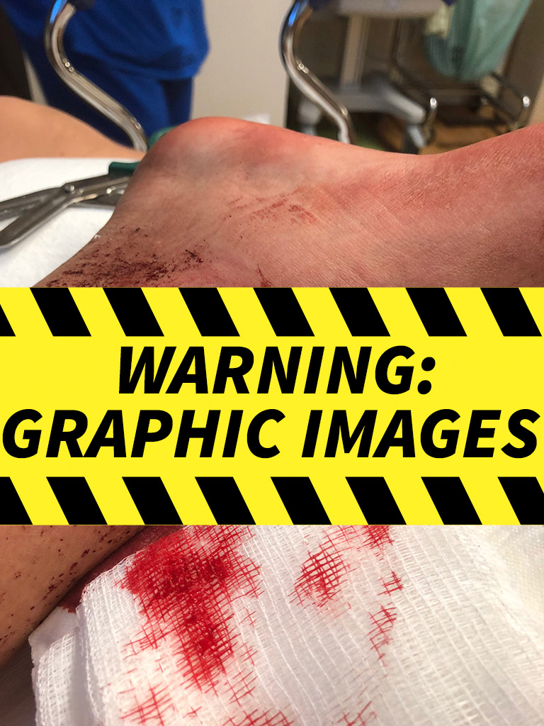 Of gunshot wounds pictures Of gunshot wounds pictures